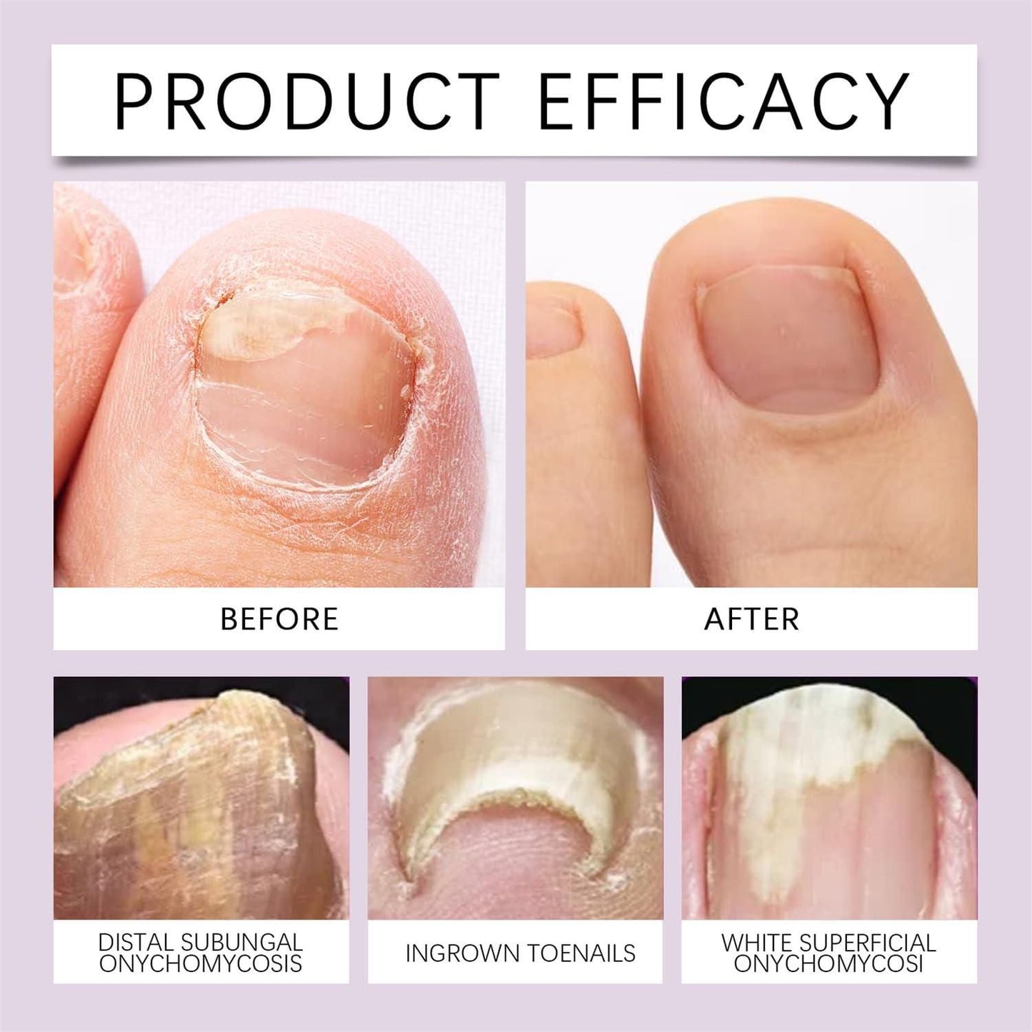 🧴 Fungi-Free Bee Venom Nail Treatment Solution Serum